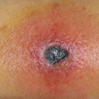 
	Disseminated aspergillus infection&nbsp;