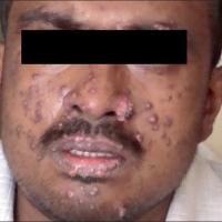 
	Disseminated histoplasmosis associated with HIV