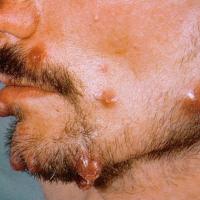 
	Bacillary angiomatosis associated with HIV