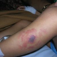 
	Zygomycosis in an immunosuppressed patient&nbsp;