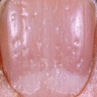 
	Alopecia areata and nail pitting