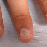 
	Alopecia areata and trachyonychia