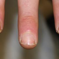
	Darier's disease

	V-shaped notch in the…