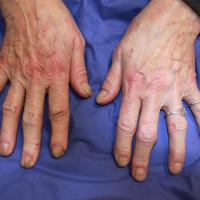 
	Eczema and nail changes