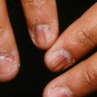 
	Longitudinal melanonychia in a darker-skinned…
