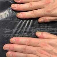 Habit-tic nail deformity
Patient admitted to…
