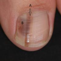 Just occasionally a subungual melanoma can…