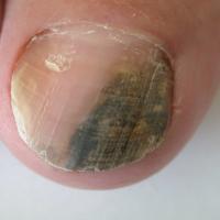 
	Fungal infection of the nail caused by Fusarium…