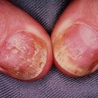 
	Nail psoriasis

	Multiple pits
