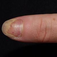 
	Nail psoriasis

	Onycholysis