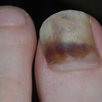 
	Subungual haematoma

	Clear nail growth…