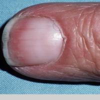 
	Terry's nails