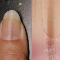 
	Longitudinal melanonychia - benign

	A biopsy…