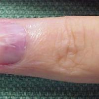 
	Glomus tumour - benign 

	A red / blue area of…