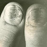 
	Habit-tic nail deformity
Fir tree appearance