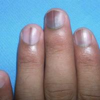 
	Longitudinal melanonychia: drug-induced