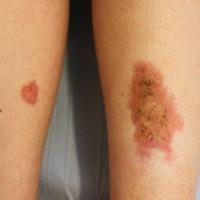 
	Necrobiosis lipoidica - both shins

	The patch…