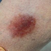 
	Necrobiosis lipoidica

	An early lesion, as yet…