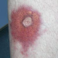 
	Necrobiosis lipoidica with a healed ulcer