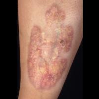 
	Necrobiosis lipoidica

	Central atrophy,…