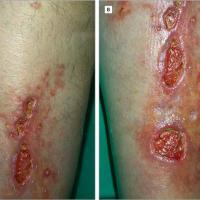 
	Necrobiosis lipoidica with extensive ulceration 