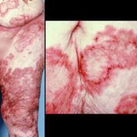 Necrolytic migratory erythema