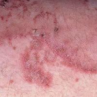 
	Necrolytic migratory erythema