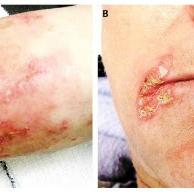 
	Necrolytic migratory erythema