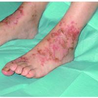 
	Necrolytic migratory erythema
