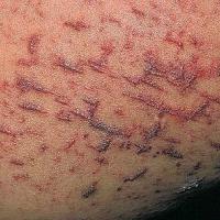 
	Keratosis lichenoides chronica