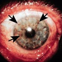 
	Lisch nodules