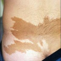 
	McCune-Albright syndrome, not NF1