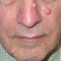 
	NF1 - multiple cutaneous neurofibromas on the…