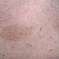 
	Cafe-au-lait patches

	&nbsp;