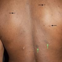 
	NF1

	Cutaneous neurofibromas (black arrows)…