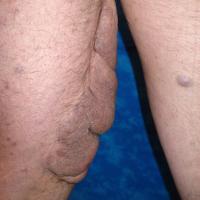 
	Plexiform neurofibroma of the thigh