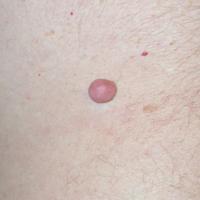 
	Solitary neurofibroma

	Unassociated with NF1
