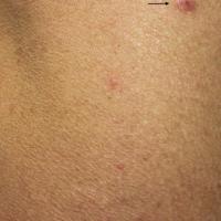 
	Papular prurigo 

	This lady had itchy lesions…