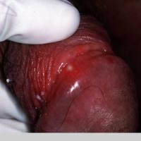 
	Beh&ccedil;et syndrome