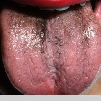 
	Hairy tongue