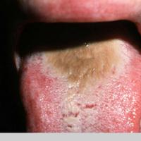 
	Hairy tongue