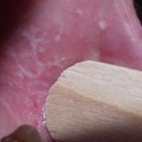 
	Lichen planus&nbsp;

	Copied with kind…