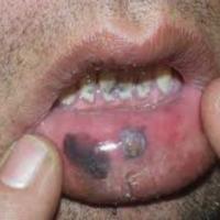 
	Melanoma of the lips