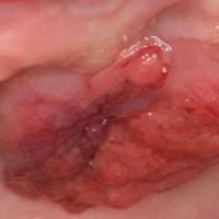 
	Exophytic SCC