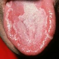 
	Geographic tongue