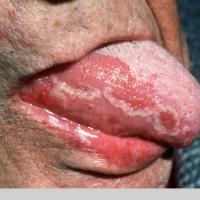 
	Geographic tongue