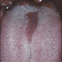 
	Median rhomboid glossitis