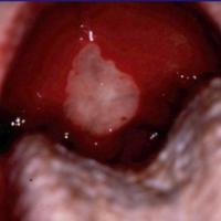 
	Major aphthous ulcer