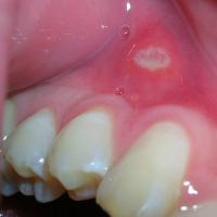 
	Minor aphthous ulcer