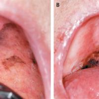 
	Melanoma